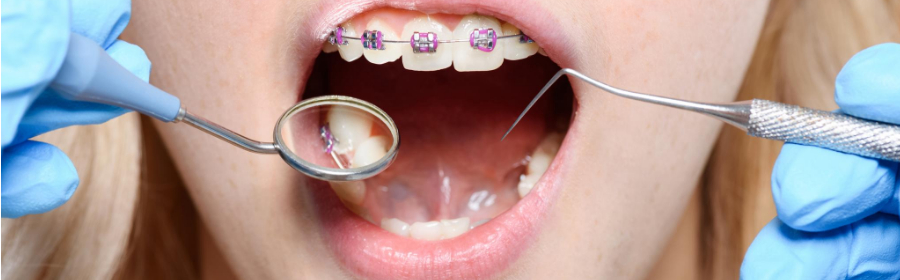 Bite problems that can be fixed with Braces