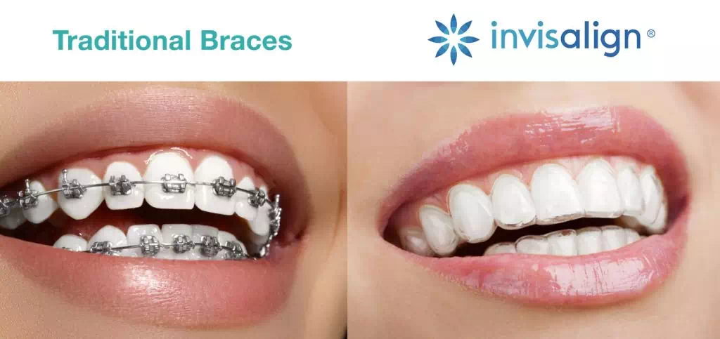 IVISALIGN VS. BRACES – WHICH IS THE RIGHT CHOICE?