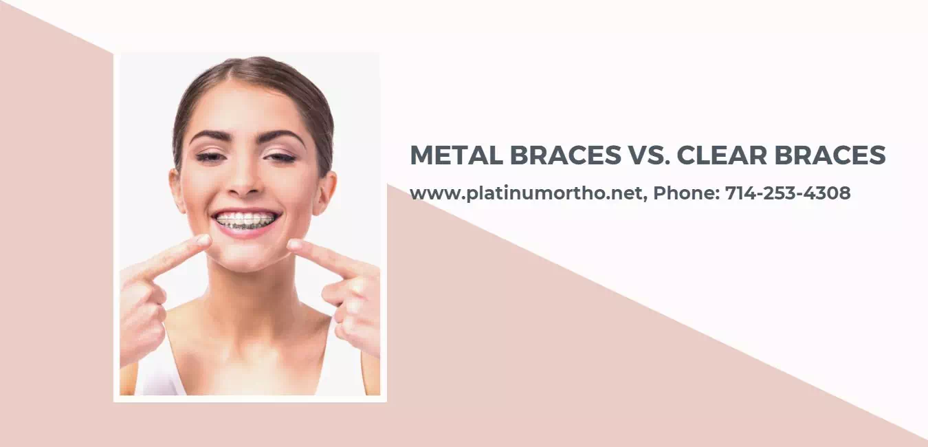 Metal Braces vs. Clear Braces