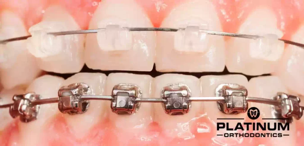 TRADITIONAL METAL BRACES