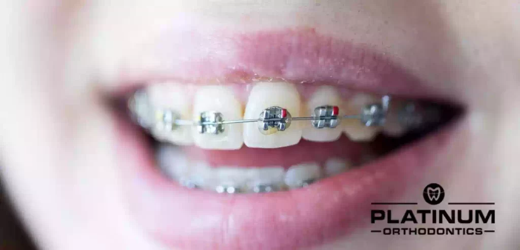 Adult Braces in Fullerton, not just for kids