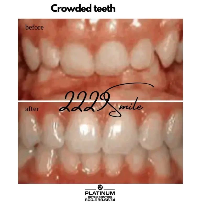 Crowded teeth
