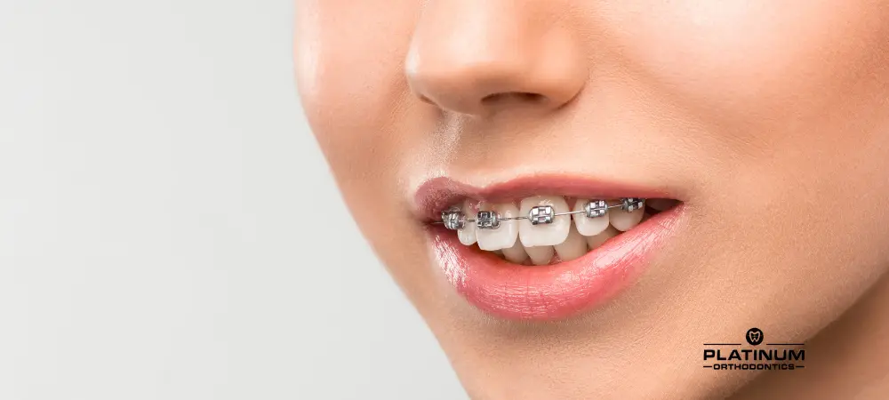 Deep Overbite: Understanding This Common Dental Condition