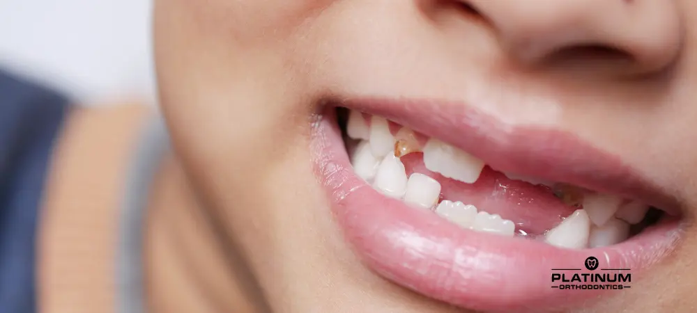 Missing Teeth: Understanding Causes, Consequences, and Solutions