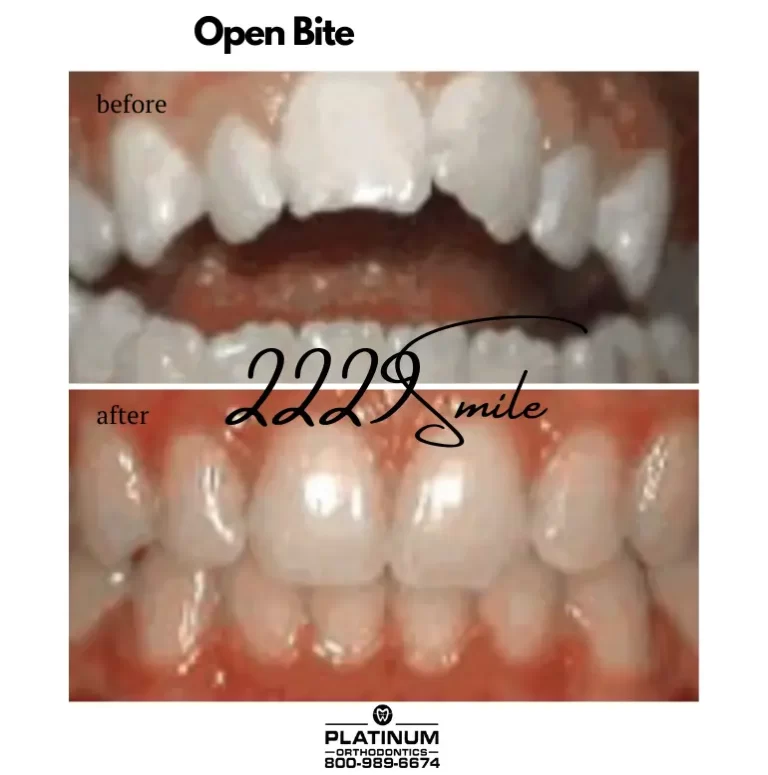 Open Bite