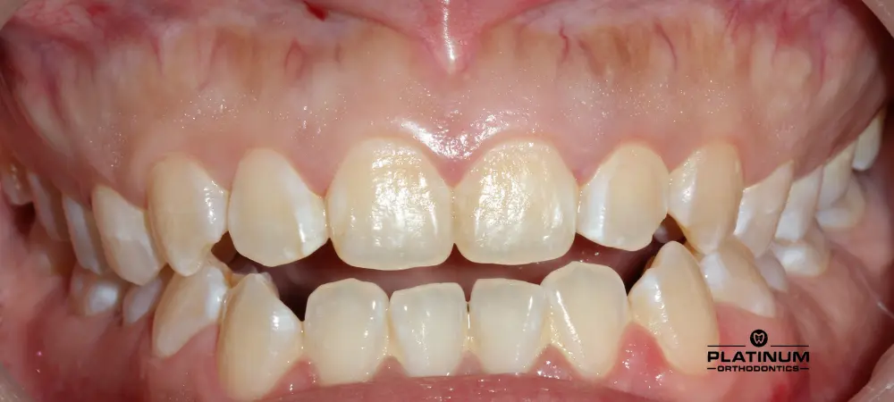 Open Bite – Front Teeth Don’t Touch