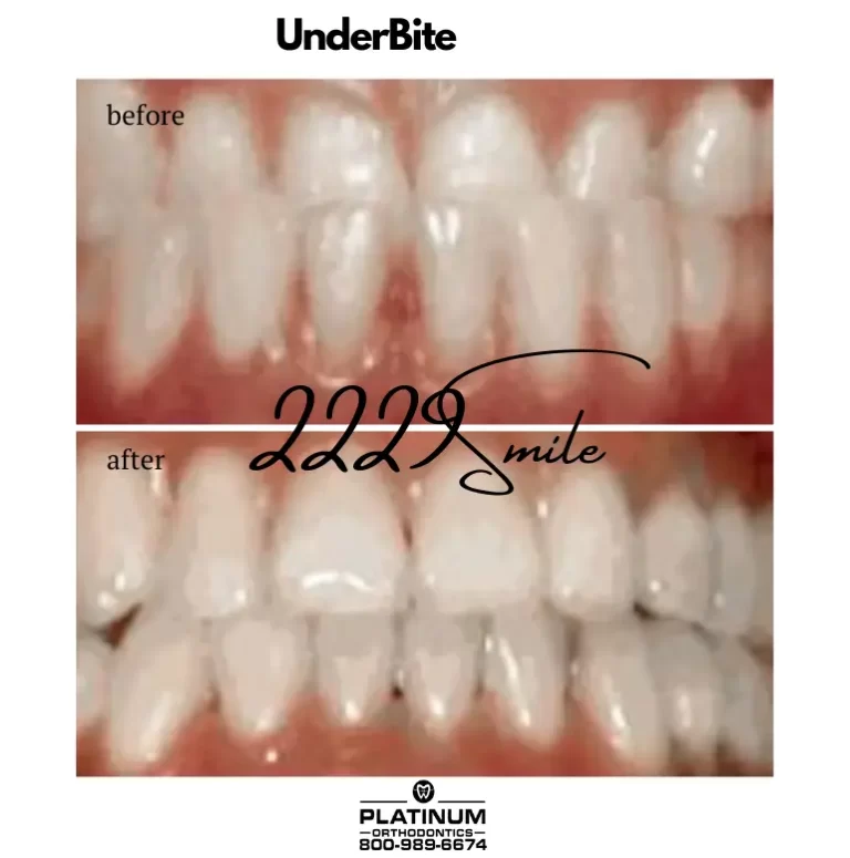 UnderBite