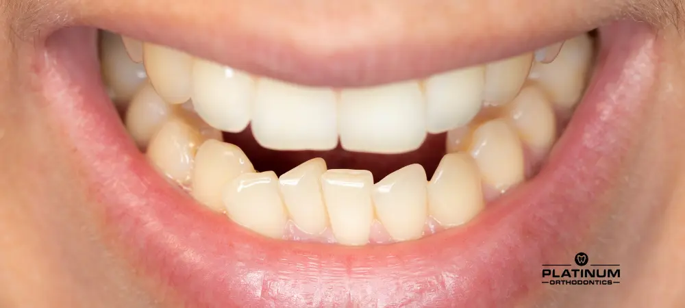 Understanding Underbites: Causes, Effects, and Treatment Options